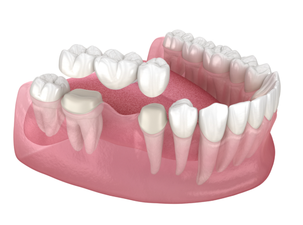 Cầu răng sứ luôn giữ màu sắc trắng sáng như răng thật