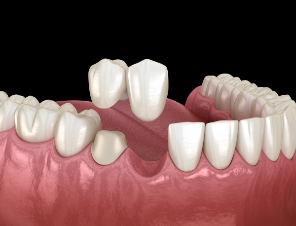 Cầu răng sứ đèo giúp bảo tồn răng thật thêm phần bền chắc và lâu dài