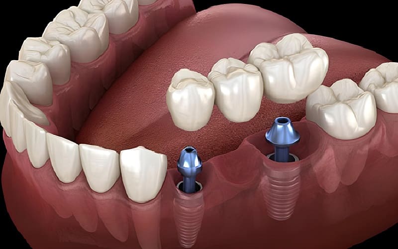 Cầu răng sứ trên trụ Implant giúp răng chắc khỏe, bền chắc theo thời gian
