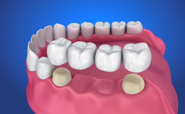 Cầu răng sứ truyền thống là phương pháp phổ biến được nhiều khách hàng tin dùng nhất hiện nay