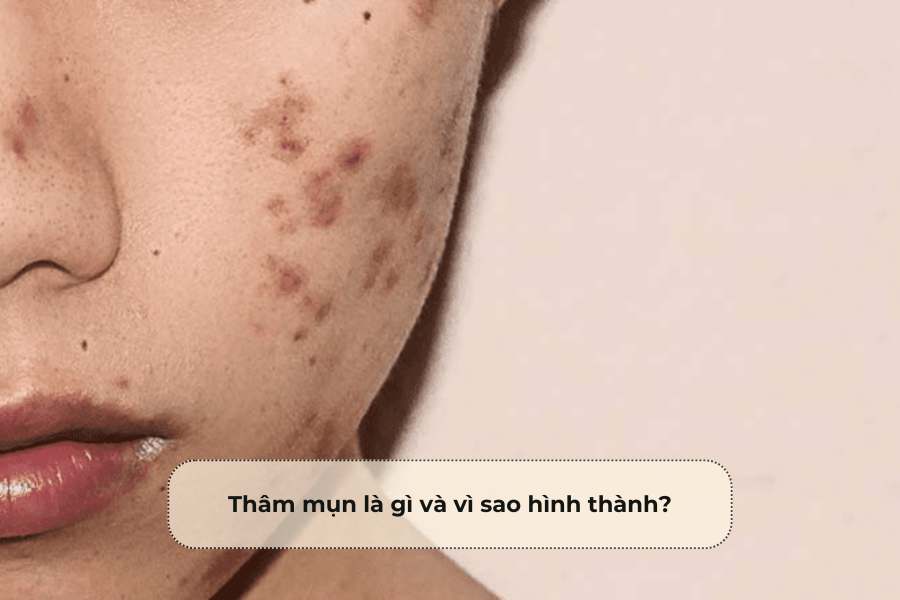 Thâm nhập là gì và vì sao hình thành